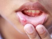 Sức khỏe - Dấu hiệu ung thư miệng nhiều người tưởng bệnh nhẹ nên bỏ qua