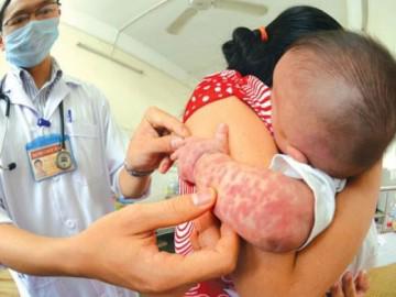 Kiêng nước không vệ sinh khi con bị sởi, chỉ sau vài tiếng răng lợi bị vi khuẩn ăn hết