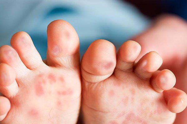 Căn bệnh nguy hiểm thời điểm giao mùa: Bệnh chân tay miệng - 3
