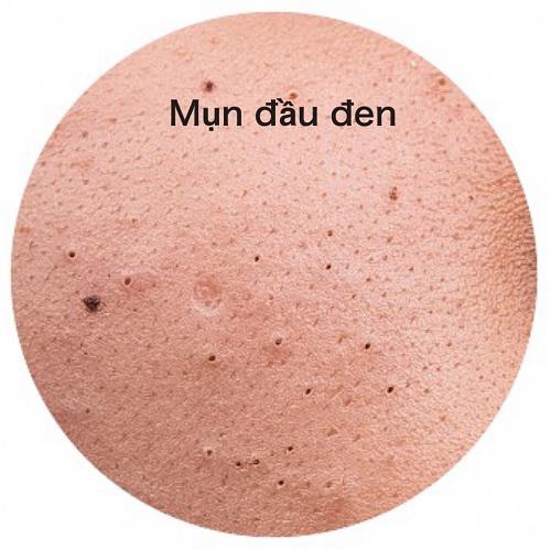 Những cách trị mụn đầu đen ở mũi bằng chanh vừa nhanh vừa đơn giản, lại vô cùng hiệu quả - 1