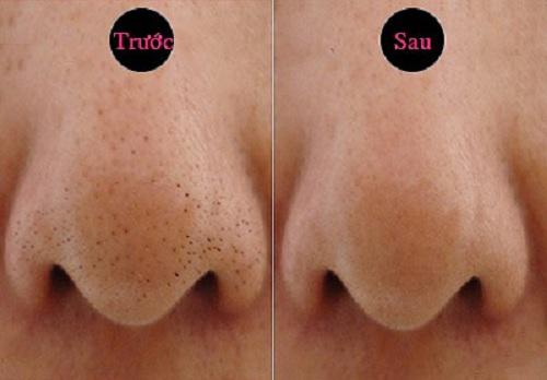 Những cách trị mụn đầu đen ở mũi bằng chanh vừa nhanh vừa đơn giản, lại vô cùng hiệu quả - 14