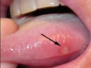 Sức khỏe - Nhiệt miệng mãi không khỏi, đi khám phải cắt 1/2 lưỡi: cách phân biệt ung thư và nhiệt miệng