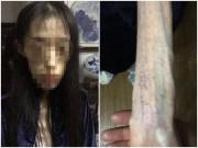 Sức khỏe - Cô gái xuất huyết não 2 lần, người gầy tới mức không ai dám nhìn vì giảm cân quá mức