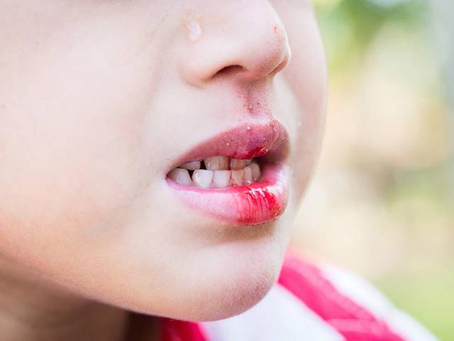 Bé 4 tháng tuổi suýt mất khả năng ăn, nói vì mẹ chủ quan khi con ngã chảy máu miệng