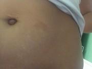 Sức khỏe - Rốn lồi ra, mẹ 2 con đi khám biết ung thư buồng trứng: 8 dấu hiệu mẹ đừng xem nhẹ