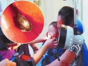 Làm mẹ - Con bị chảy máu cam, mẹ tưởng ốm thường, bác sĩ gắp dị vật trong mũi mới "đứng hình"