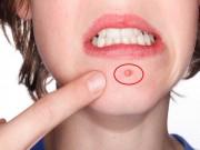 Làm đẹp - Có ngay 10 cách trị mụn bọc cực dễ ngay tại nhà mà các cô nàng không nên bỏ qua