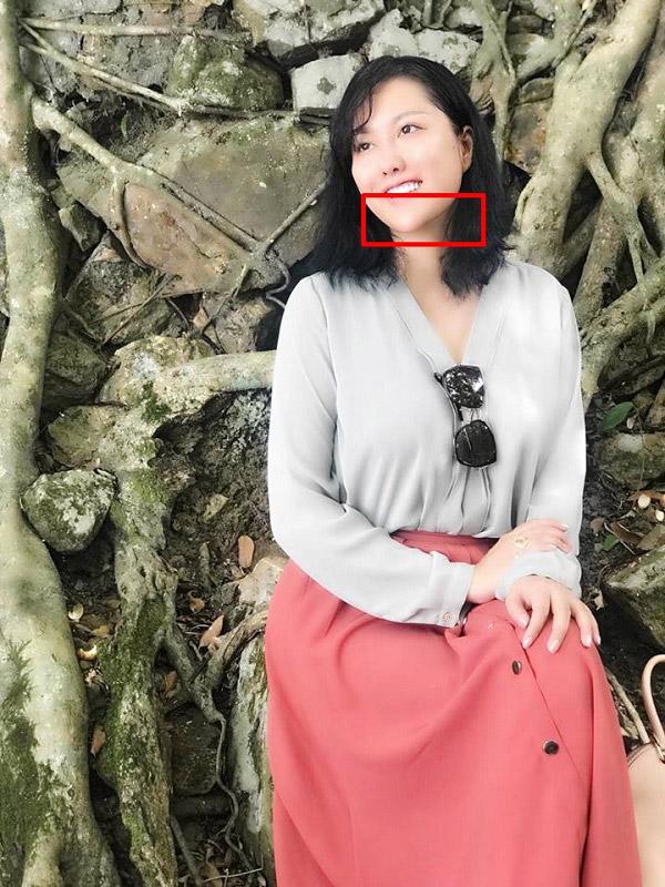 Mũi biến dạng, cằm lệch một bên, Phi Thanh Vân đối diện với biến chứng sau nhiều lần dao kéo? - 5