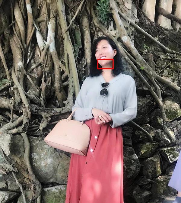 Mũi biến dạng, cằm lệch một bên, Phi Thanh Vân đối diện với biến chứng sau nhiều lần dao kéo? - 4