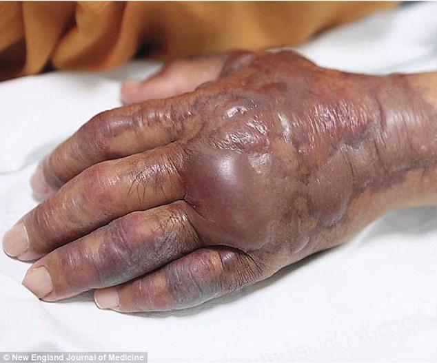 bi sot cao sau khi an sushi, 25 ngay sau nguoi dan ong phai nhan cai ket dau don - 2