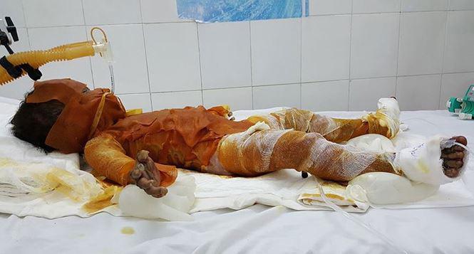 bo me di lam xa gui chau cho ba, 3 chi em dot rac khien be 2 tuoi bong 90% - 1