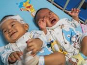 Làm mẹ - Cặp song sinh mắc bệnh nguy hiểm phải bốc thăm để chọn sống và kết cục đau lòng