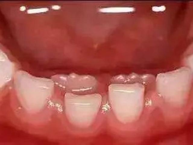 Cậu bé 7 tuổi bị hàm răng đôi, cảnh báo do thói quen chiều con khi ăn của cha mẹ