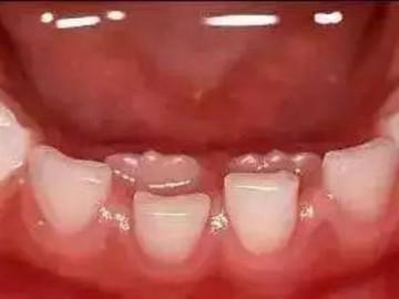 Cậu bé 7 tuổi bị “hàm răng đôi”, cảnh báo do thói quen chiều con khi ăn của cha mẹ