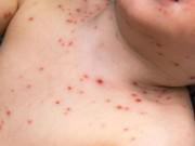 Sức khỏe - Thủy đậu kiêng gì? Dấu hiệu và cách điều trị bệnh