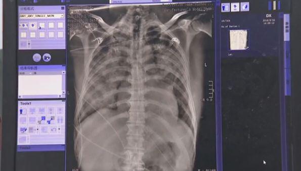 Người đàn ông chết sau 1 ngày nằm viện, thứ cướp đi sinh mạng của ông lại rất nhỏ bé - 2