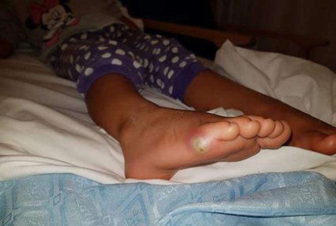 Bé gái 4 tuổi nhiễm trùng máu vì... thử giày mà không đi tất - 1