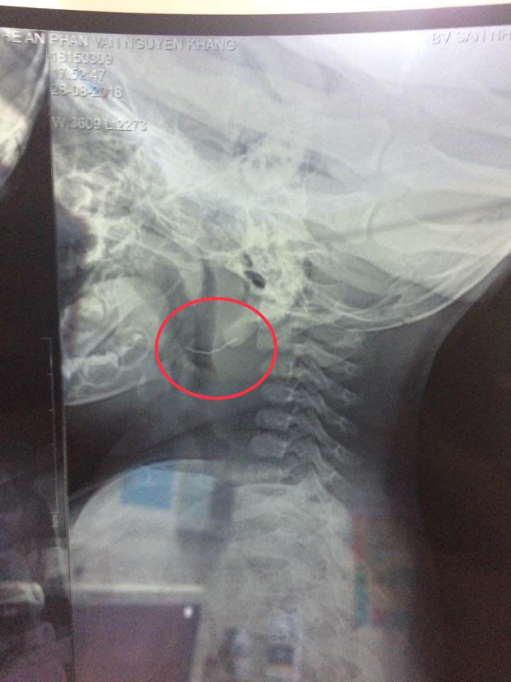 Bé 11 tháng Nghệ An bị hóc sau ăn cháo lươn, BS gắp dị vật khiến cả nhà bất ngờ - 1