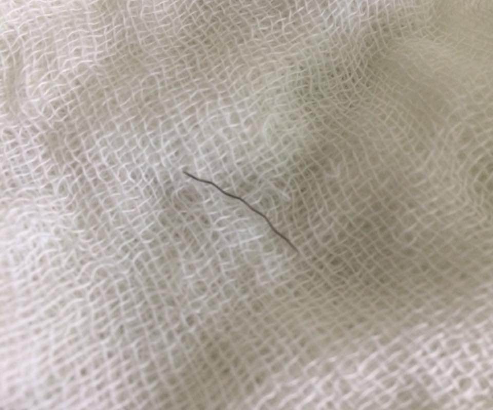 Bé 11 tháng Nghệ An bị hóc sau ăn cháo lươn, BS gắp dị vật khiến cả nhà bất ngờ - 2