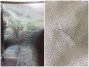 Làm mẹ - Bé 11 tháng Nghệ An bị hóc sau ăn cháo lươn, BS gắp dị vật khiến cả nhà bất ngờ