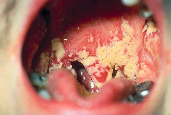 Viêm phổi ở trẻ em: Nguyên nhân và cách điều trị do bác sĩ hướng dẫn - 3