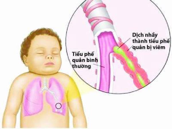 Viêm phổi ở trẻ em: Nguyên nhân và cách điều trị do bác sĩ hướng dẫn - 4
