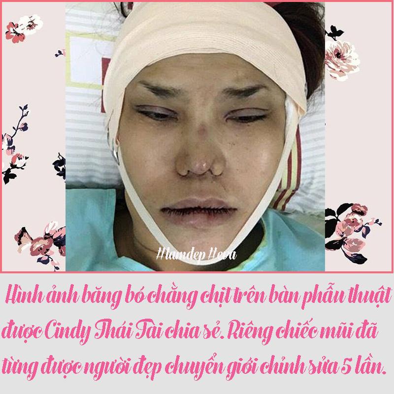 Hình ảnh băng bó chằng chịt trên bàn phẫu thuật được Cindy Thái Tài.
