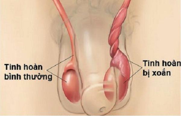 Tưởng con đau bụng thường, mẹ Hưng Yên ngỡ ngàng khi bác sĩ nói phải cắt bỏ tinh hoàn - 2