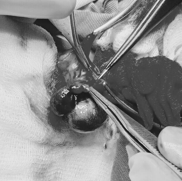 Tưởng con đau bụng thường, mẹ Hưng Yên ngỡ ngàng khi bác sĩ nói phải cắt bỏ tinh hoàn - 1