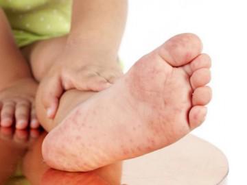 7 điều cha mẹ cần biết về bệnh tay chân miệng ở trẻ em