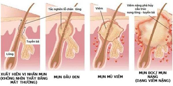 7 Cách trị mụn bọc ở mũi từ nguyên liệu thiên nhiên tại nhà - 2