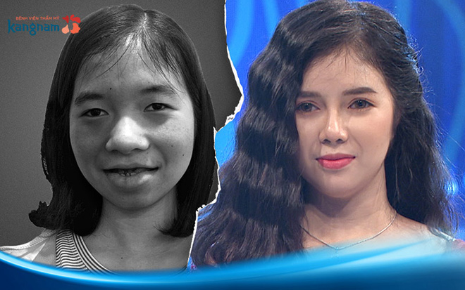 108 ngày, 5 lần PTTM - chặng đường gian nan tìm lại nụ cười của cô gái “ma cà rồng” - 1