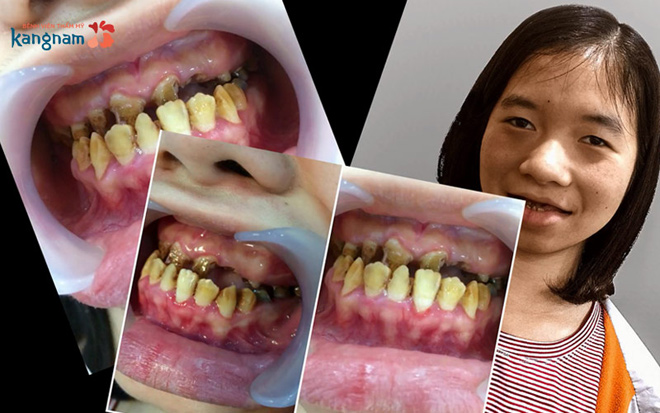 108 ngày, 5 lần PTTM - chặng đường gian nan tìm lại nụ cười của cô gái “ma cà rồng” - 2