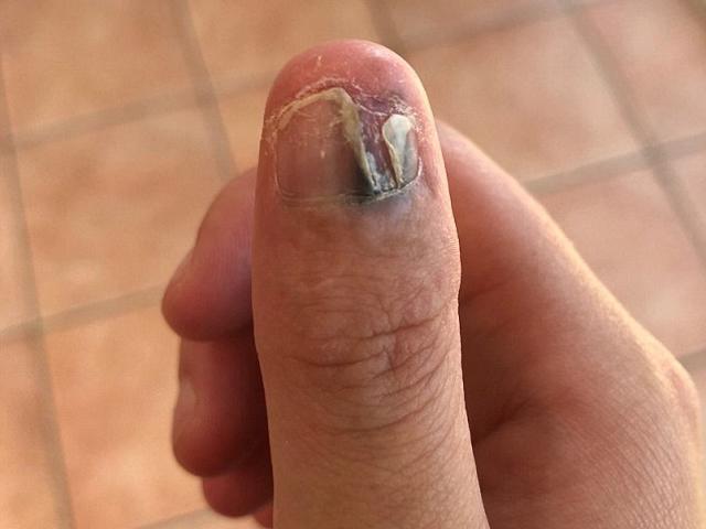 Cô gái 20 tuổi bị ung thư da vì thường xuyên cắn móng tay