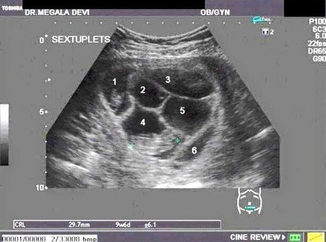 6 em bé chào đời trong ca đẻ mổ với sự giúp đỡ của 35 bác sĩ giờ ra sao? - 2