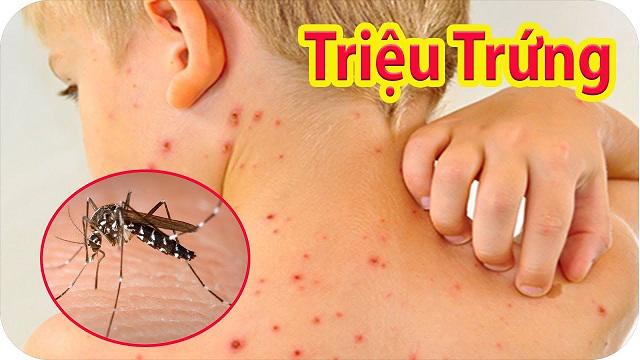 sot xuat huyet o tre em: 5 trieu chung pho bien khong duoc bo qua - 5