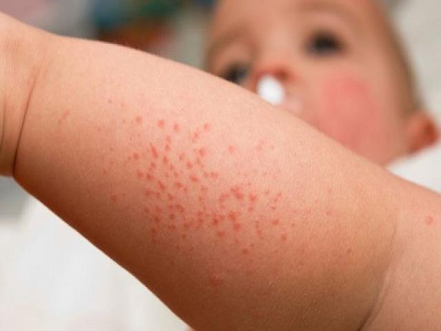 Sốt xuất huyết ở trẻ em: 5 triệu chứng phổ biến không được bỏ qua