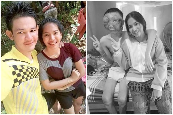 Chuyện tình cảm động của cô gái trẻ và chàng trai bị biến dạng mặt vì ung thư mắt - 1