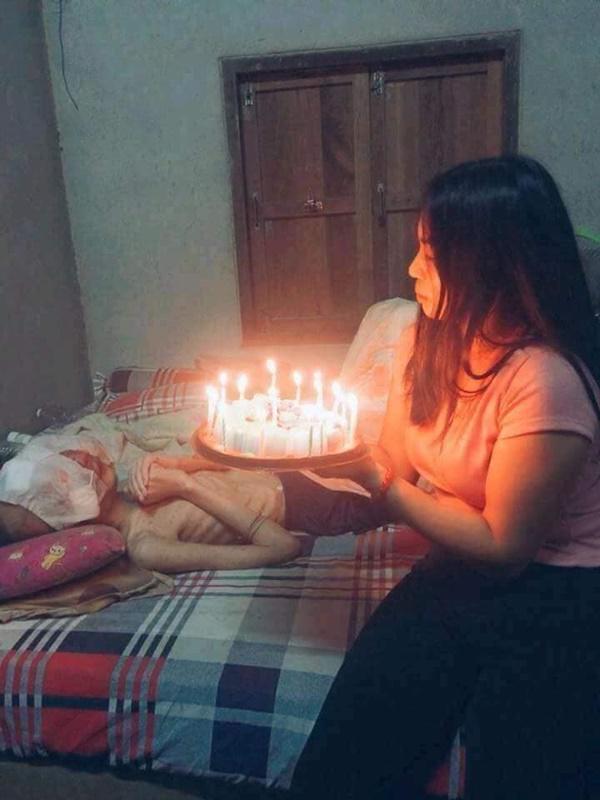 Chuyện tình cảm động của cô gái trẻ và chàng trai bị biến dạng mặt vì ung thư mắt - 4