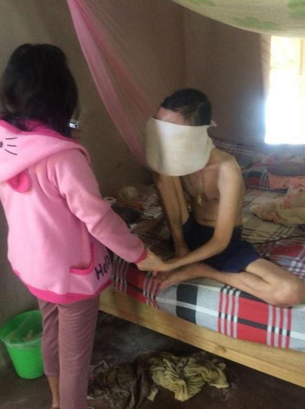 Chuyện tình cảm động của cô gái trẻ và chàng trai bị biến dạng mặt vì ung thư mắt - 3