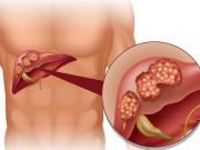 Sức khỏe - Dấu hiệu ung thư gan và các giai đoạn nhất định bạn phải biết