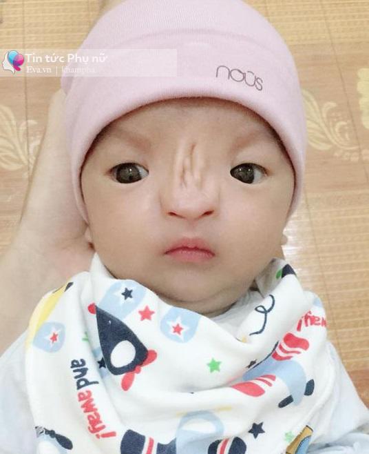Lỡ uống thuốc khi mới cấn thai, mẹ Ninh Bình xót lòng nhìn con sinh ra không có mũi - 1