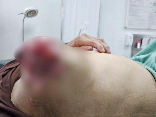 Đắp lá chữa ung thư vú, người phụ nữ phải nhập viện vì bị lở loét, chảy dịch