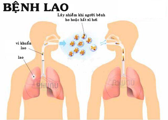 5 tre o truong mau giao bi benh lao, phu huynh nhat dinh phai hieu ro benh nay - 2