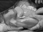 Tin tức - Ca sinh 3 hy hữu: 2 bé chào đời vẫn ngủ ngon trong túi ối, bác sĩ gọi mới dậy