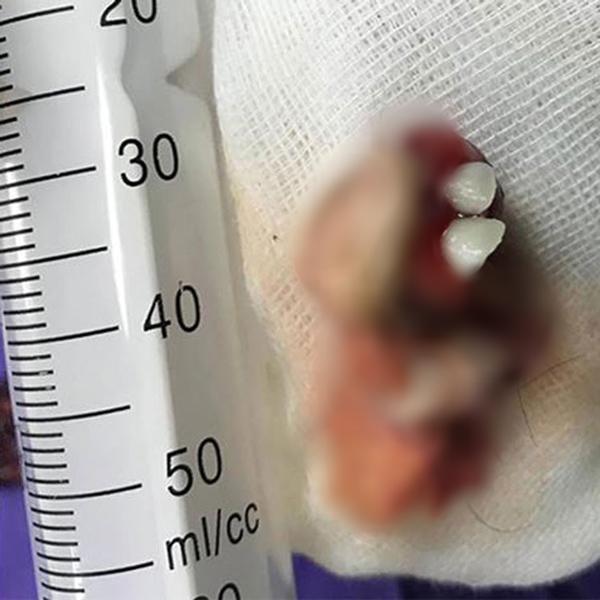 Mang thai suốt 17 năm, mẹ sốc nặng khi sinh ra vật thể lạ có cả răng và tóc - 2