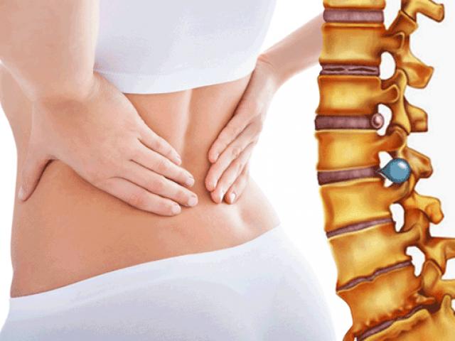 Điều trị thoát vị đĩa đệm ra sao?