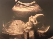 Bà bầu - Con sinh non bị đứt lìa người, mẹ khăng khăng là lỗi do bác sĩ bắt sinh thường