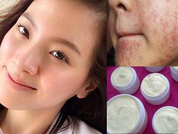 Cách thải độc cho da khi nhiễm corticoid từ kem trộn