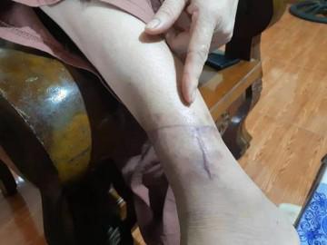 Tin mới nhất vụ nữ hộ lý bị chồng đưa lên đồi bạo hành, dùng dao cắt gân chân